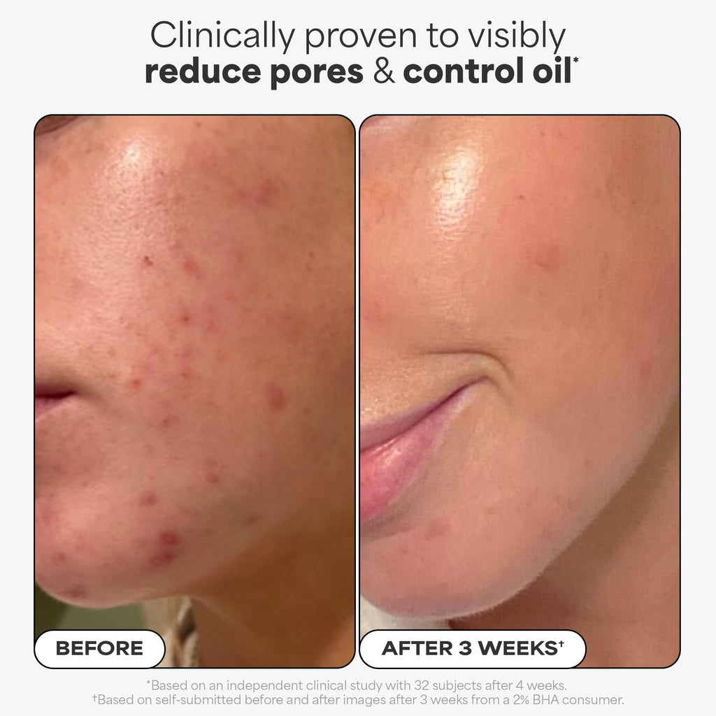 Paula's Choice Skin Perfecting 2% BHA Liquid Exfoliant Pads (10 ct) – Travel-Friendly