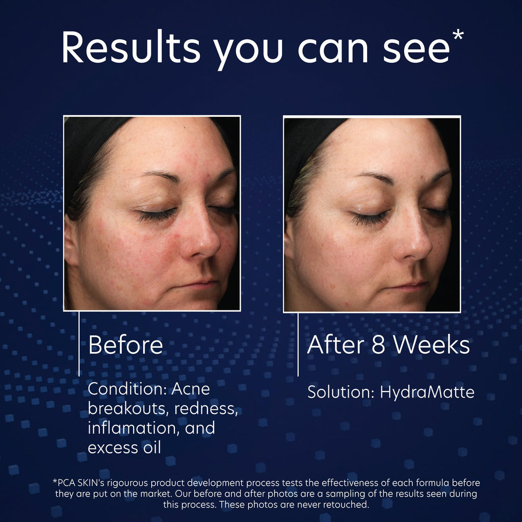 PCA SKIN HydraMatte Oil Control Moisturizer – Gel for Oily & Combination Skin | 1.8 oz