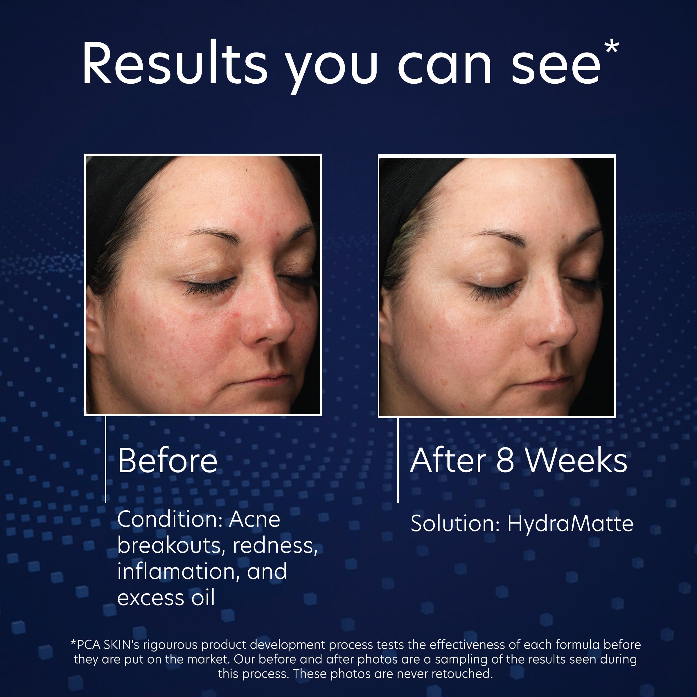 PCA SKIN HydraMatte Oil Control Moisturizer – Gel for Oily & Combination Skin | 1.8 oz