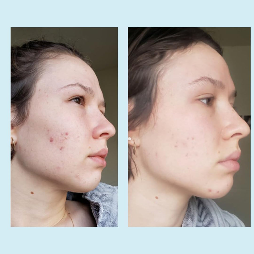 Perfect Image Glycolic Acid 50% Gel Peel with Retinol & Green Tea Extract – Professional Skin Peel, 1 oz
