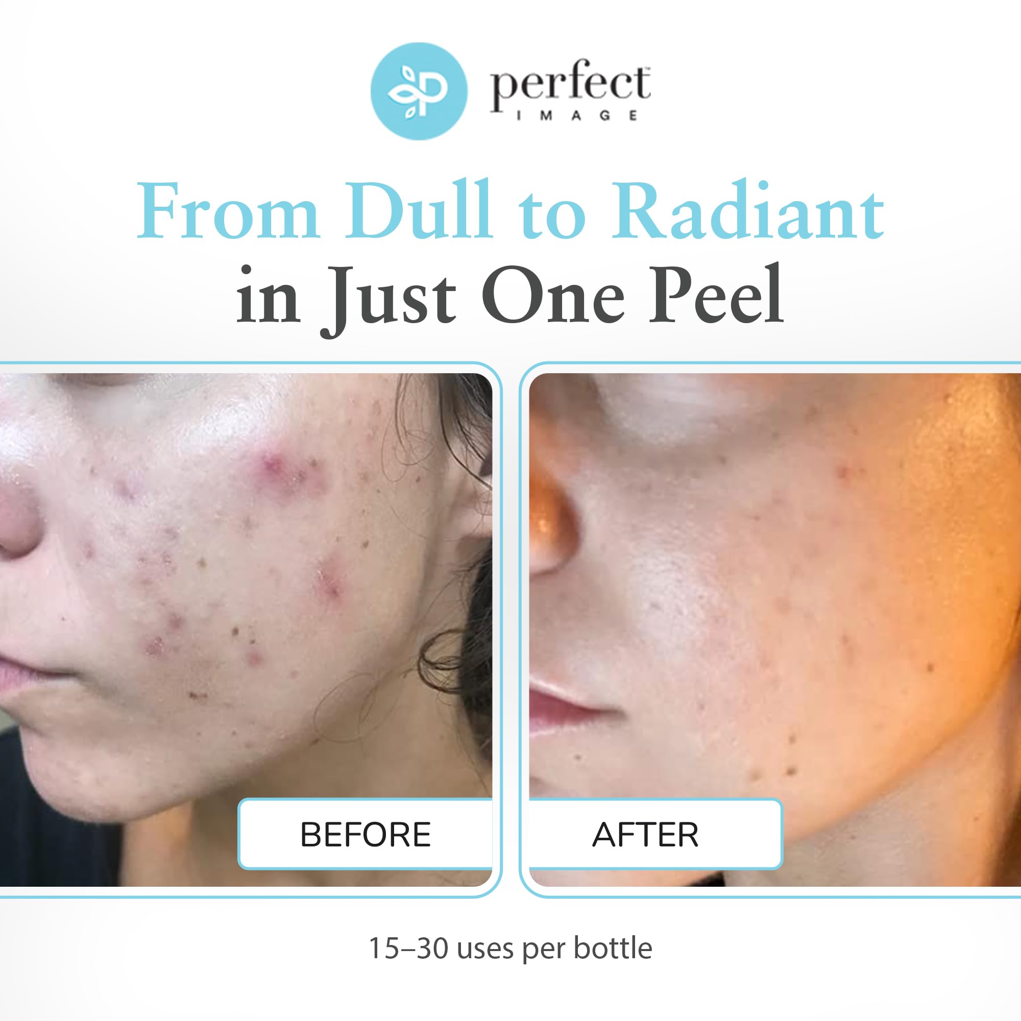 Perfect Image Glycolic 30% Gel Peel – Retinol & Green Tea, 1 oz | Professional Chemical Peel