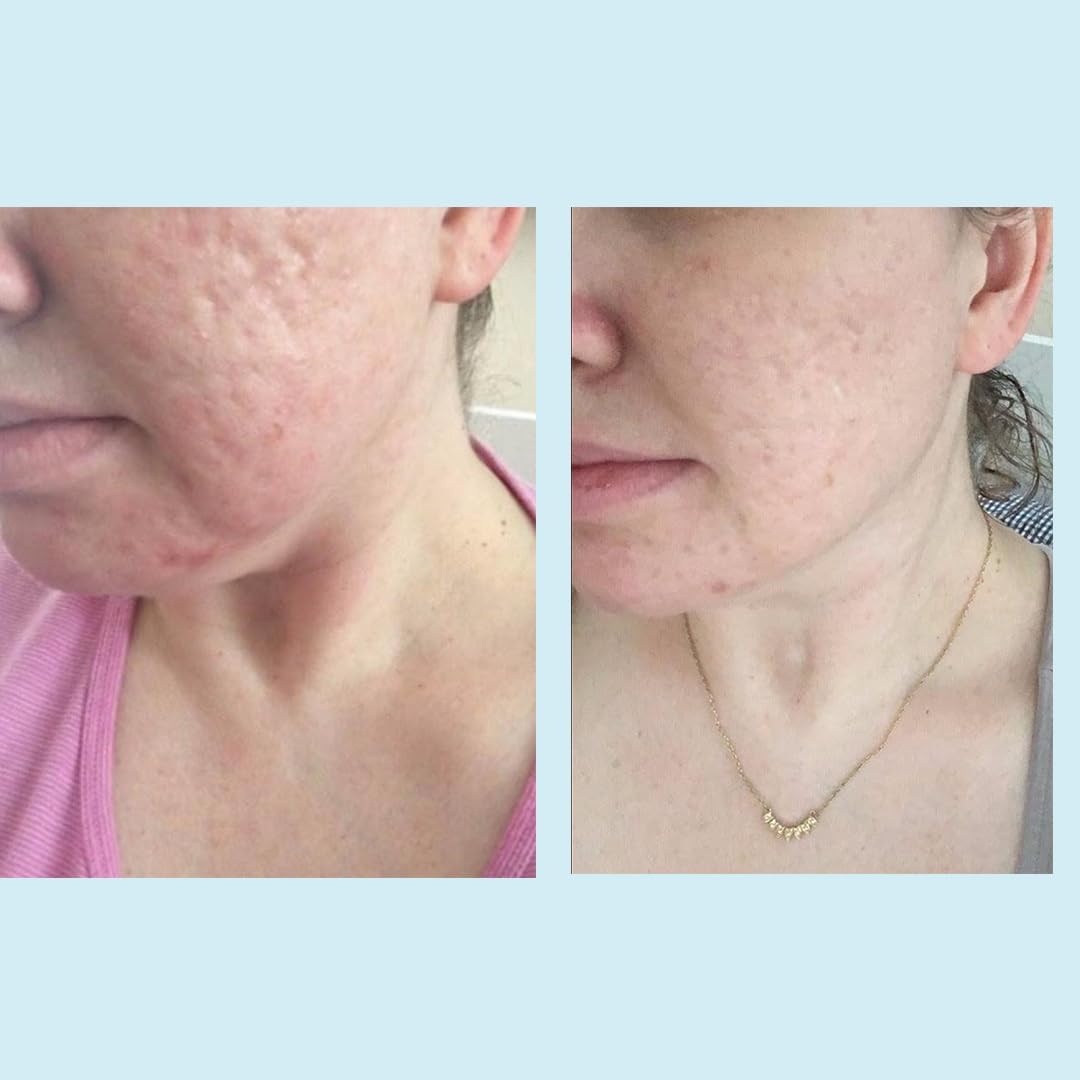 Perfect Image Glycolic Acid 50% Gel Peel with Retinol & Green Tea Extract – Professional Skin Peel, 1 oz