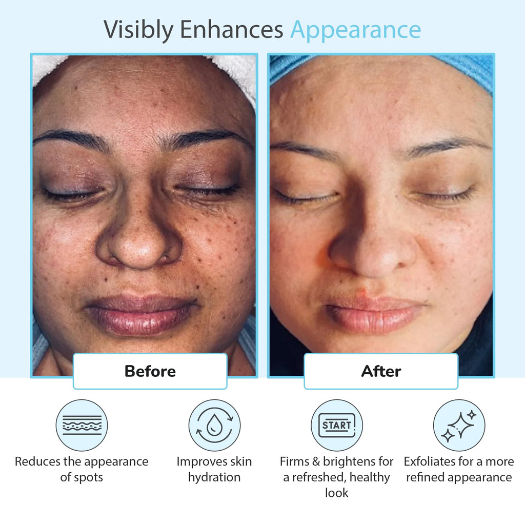 Perfect Image Glycolic Acid 50% Gel Peel with Retinol & Green Tea Extract – Professional Skin Peel, 1 oz