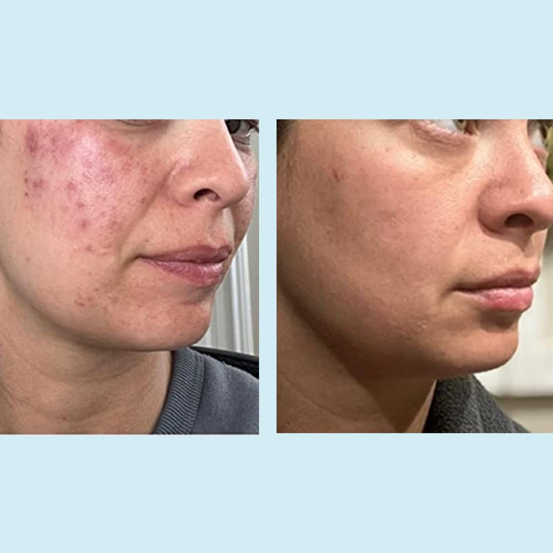 Perfect Image Glycolic Acid 50% Gel Peel with Retinol & Green Tea Extract – Professional Skin Peel, 1 oz
