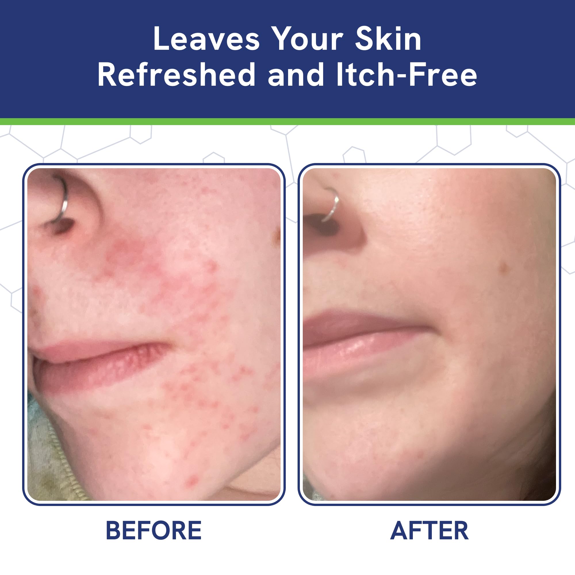 pHat 5.5 Seborrheic Dermatitis Moisturizing Cream & Face Lotion for Women – Hydrating Anti-Itch (8oz)