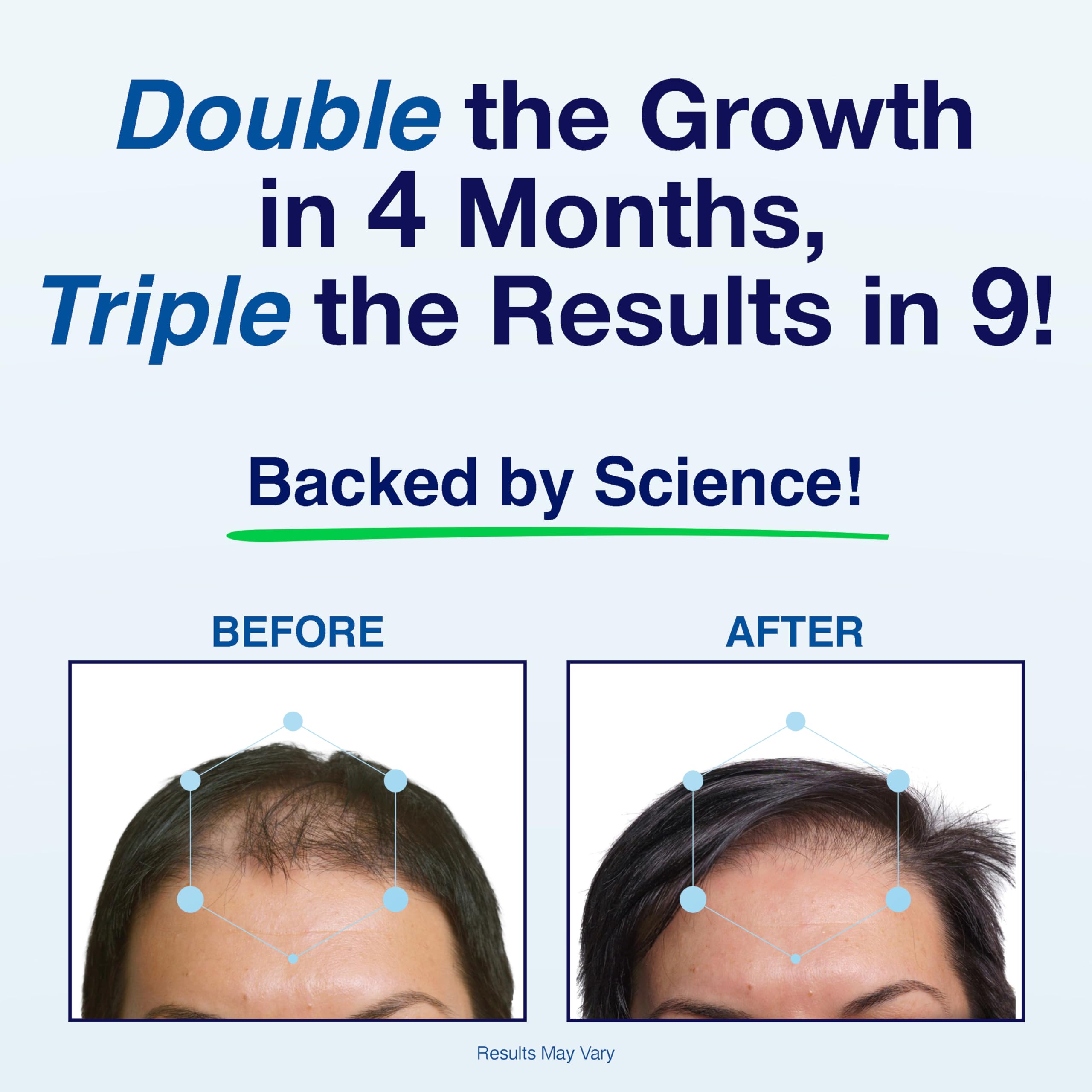 Phyllotex Patented Hair Growth Vitamins for Women & Men – Clinically Proven Hair Loss Support | Doctor Recommended | 1 Month Supply
