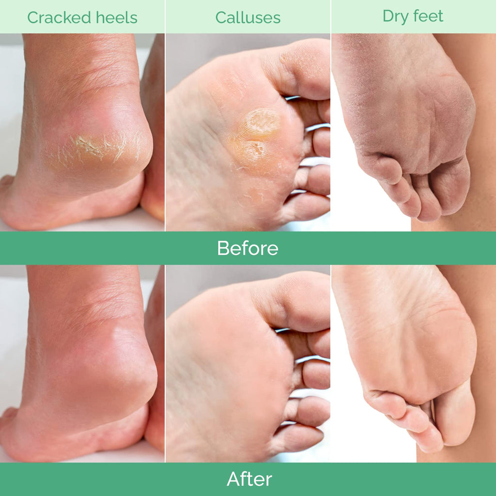 PLANTIFIQUE Foot Peeling Mask 4 Pack | Dermatologically Tested for Baby Soft Feet | Peach