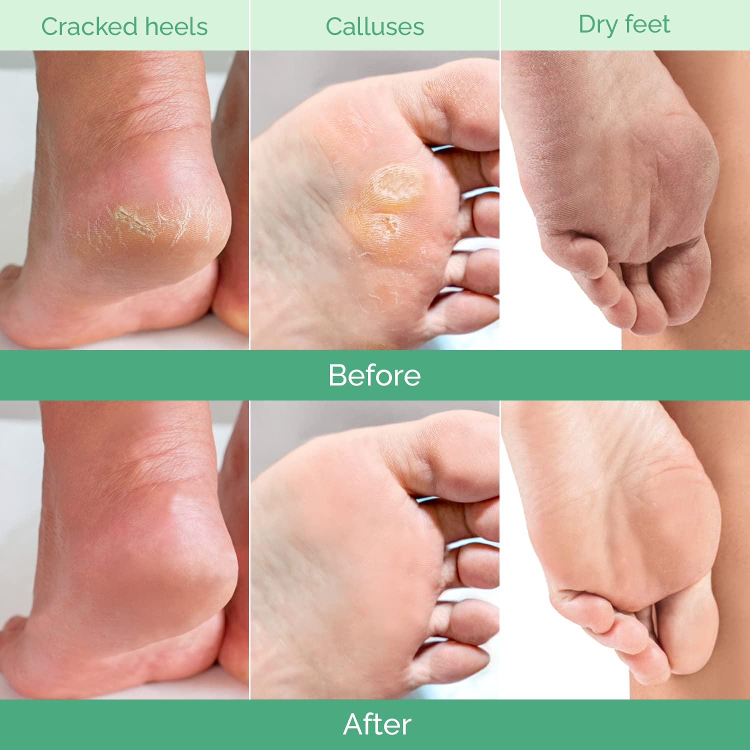 PLANTIFIQUE Foot Peeling Mask 4 Pack | Dermatologically Tested for Baby Soft Feet | Peach