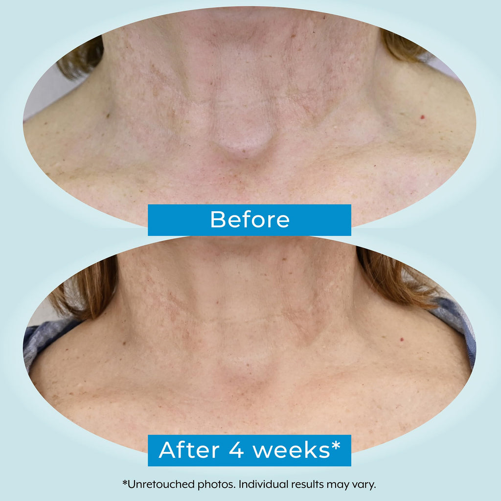 Plexaderm Dual Action Repair Neck Cream — 1 oz with Retinol, Bakuchiol & Hyaluronic Acid