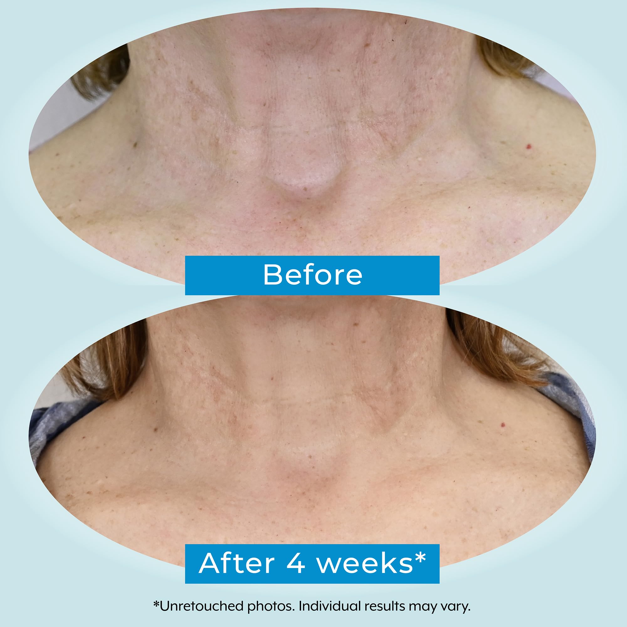 Plexaderm Dual Action Repair Neck Cream — 1 oz with Retinol, Bakuchiol & Hyaluronic Acid