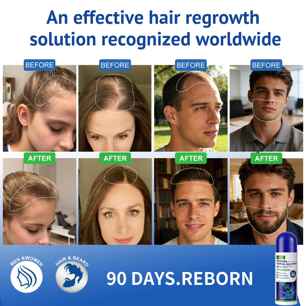 QYFJ 6 Pack 5% Minoxidil for Hair & Beard with Biotin — 8-Month Supply