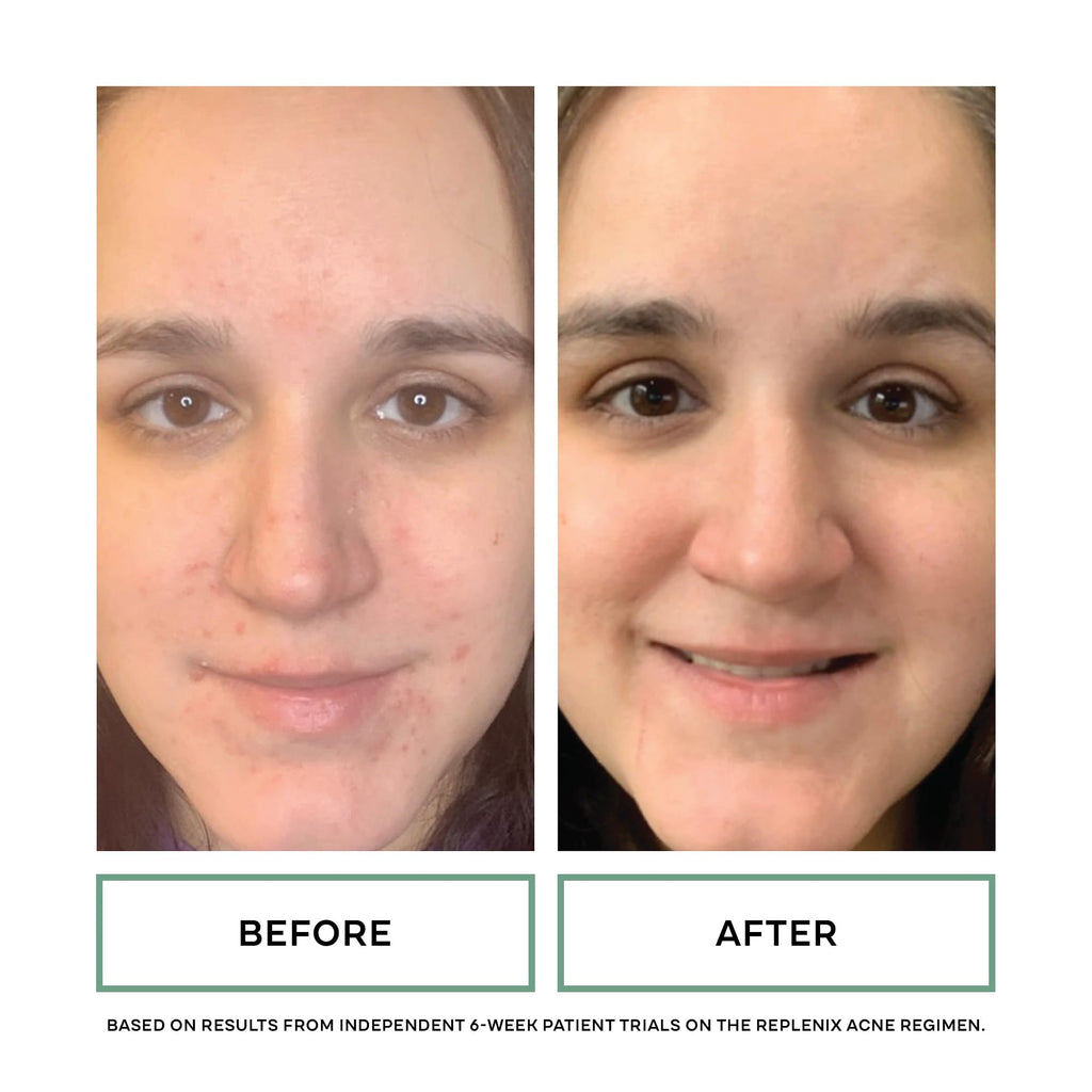 Replenix BP Acne Face Wash – 10% Benzoyl Peroxide, Non-Oily