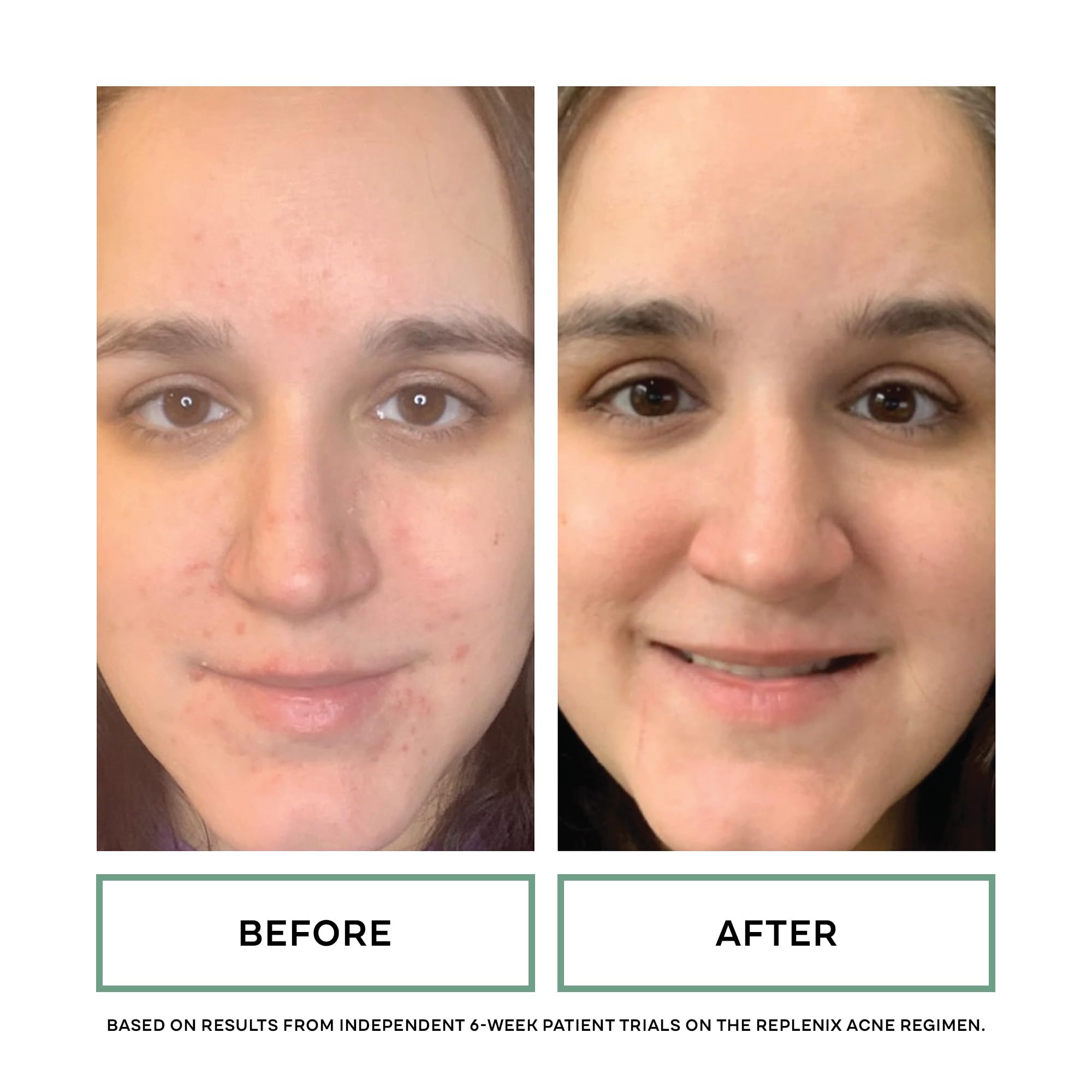 Replenix BP Acne Face Wash – 10% Benzoyl Peroxide, Non-Oily