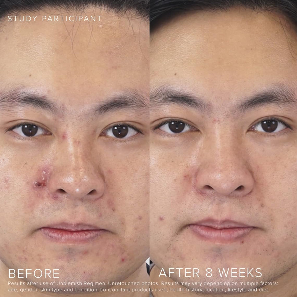 Rodan + Fields Unblemish Dual Intensive Acne Treatment | 0.76 Fl Oz | Targets Blemishes