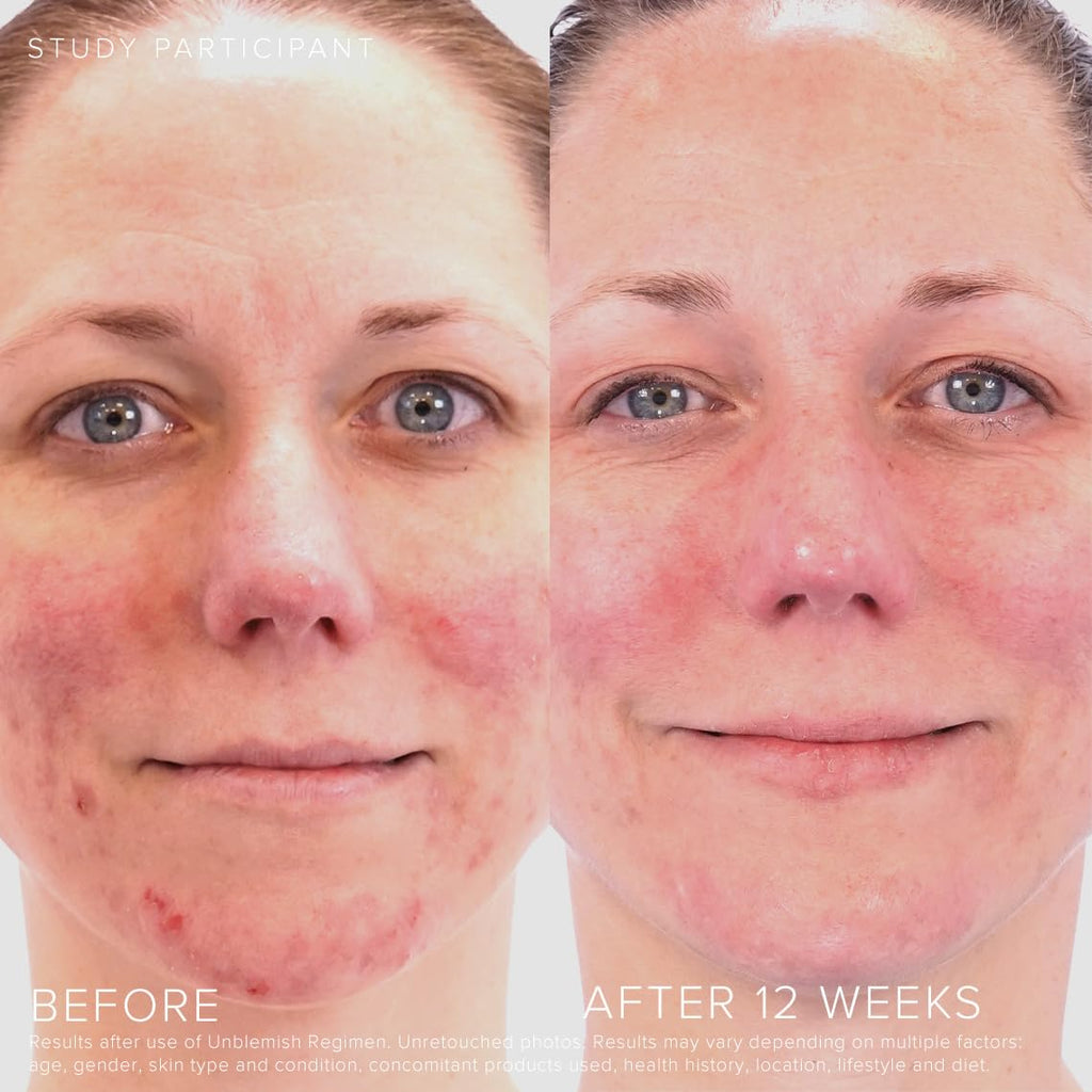 Rodan + Fields Unblemish Dual Intensive Acne Treatment | 0.76 Fl Oz | Targets Blemishes
