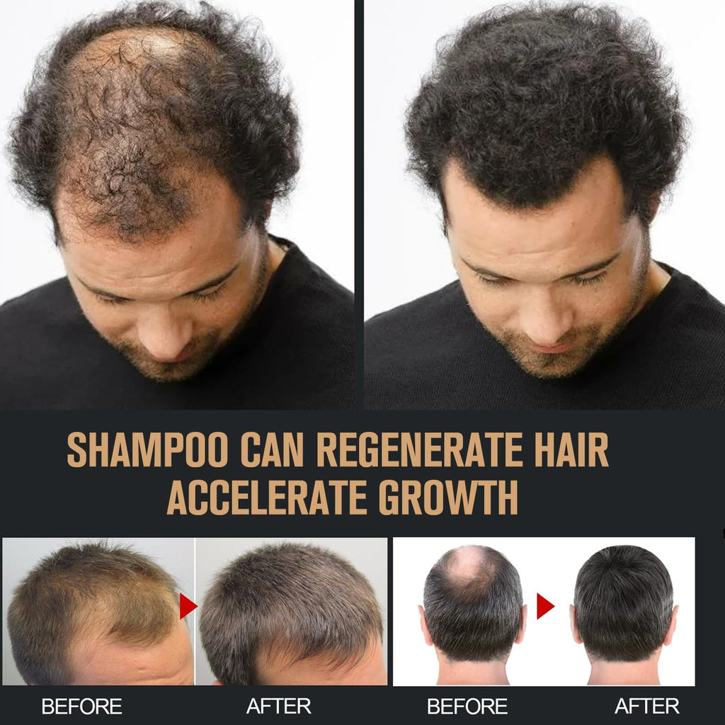 2 Pcs Root Activator Shampoo – Hair Growth Root Activator Shampoo for Anti-Hair Loss | Natural Formula for Men & Women