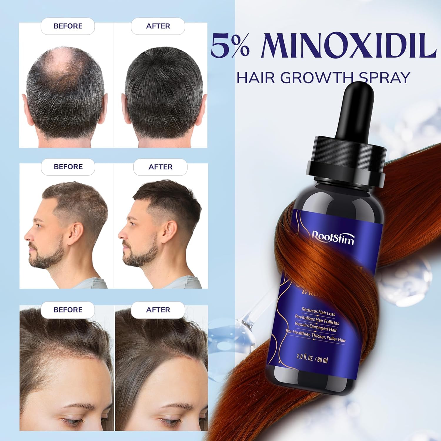 RootStim 5% Minoxidil Hair Growth Kit – Extra Strength Serum with Rosemary, 60ml