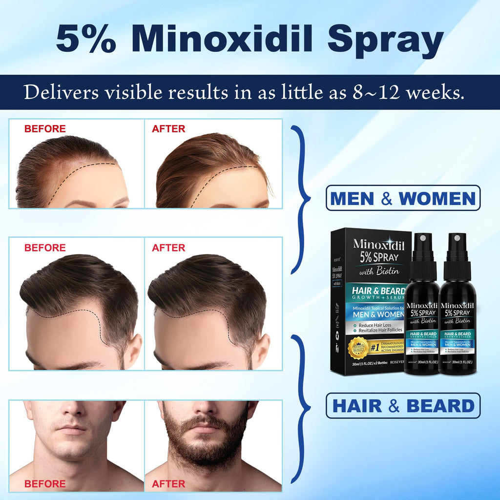 Rosever 5% Minoxidil Spray for Hair & Beard Growth – Men & Women, 2-Pack
