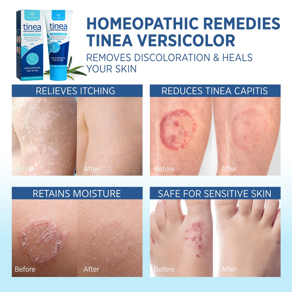 Roycederm Tinea Versicolor & Fungal Skin Cream — Multi-Functional Treatment (Pack of 2)