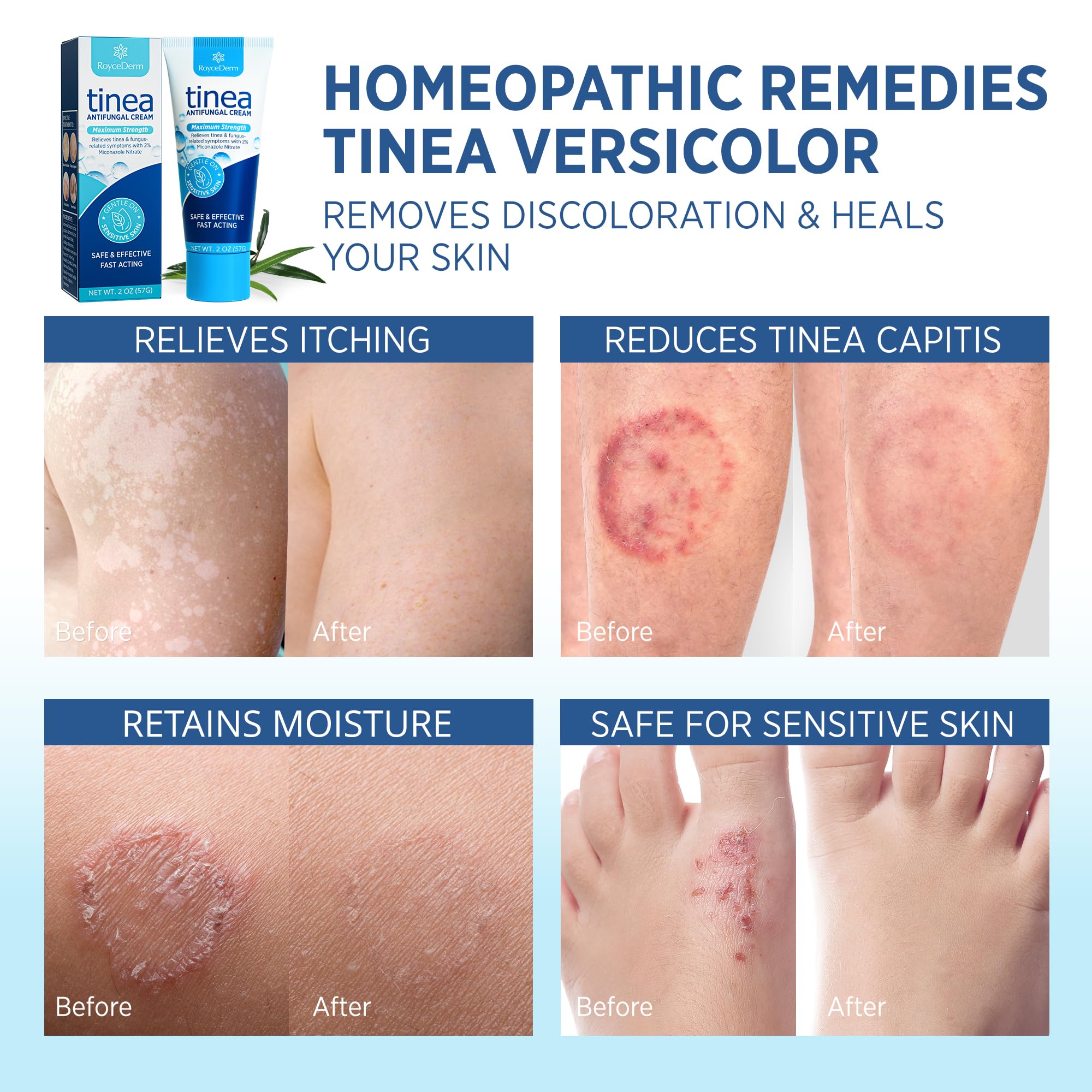 Roycederm Tinea Versicolor & Fungal Skin Cream — Multi-Functional Treatment (Pack of 2)