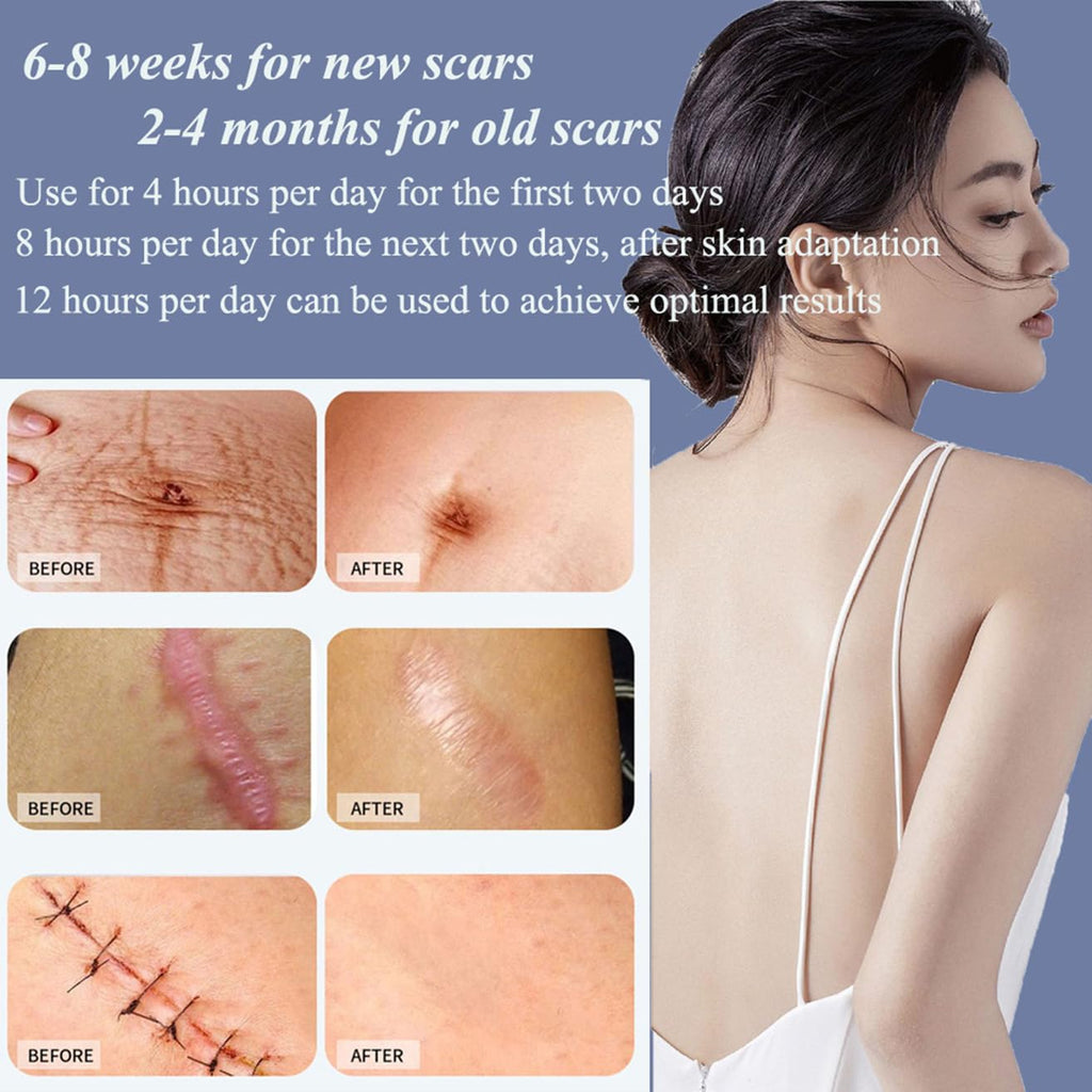 Safirst Medical Grade Silicone Scar Sheets – 1.6 x 157 in Roll for Keloid, C-Section & Burn Scars