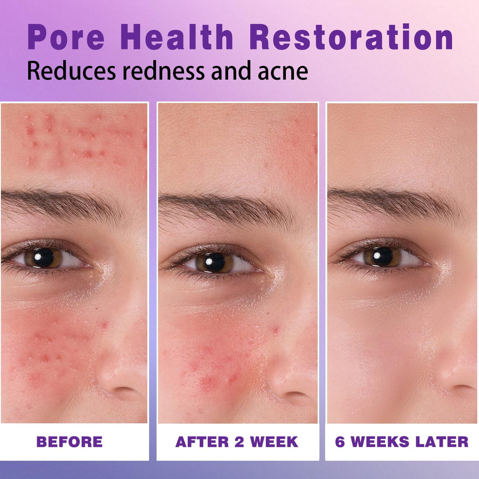 Sefralls 14% Azelaic Acid Acne Cream – Redness Relief, Acne Prevention, 1 Oz
