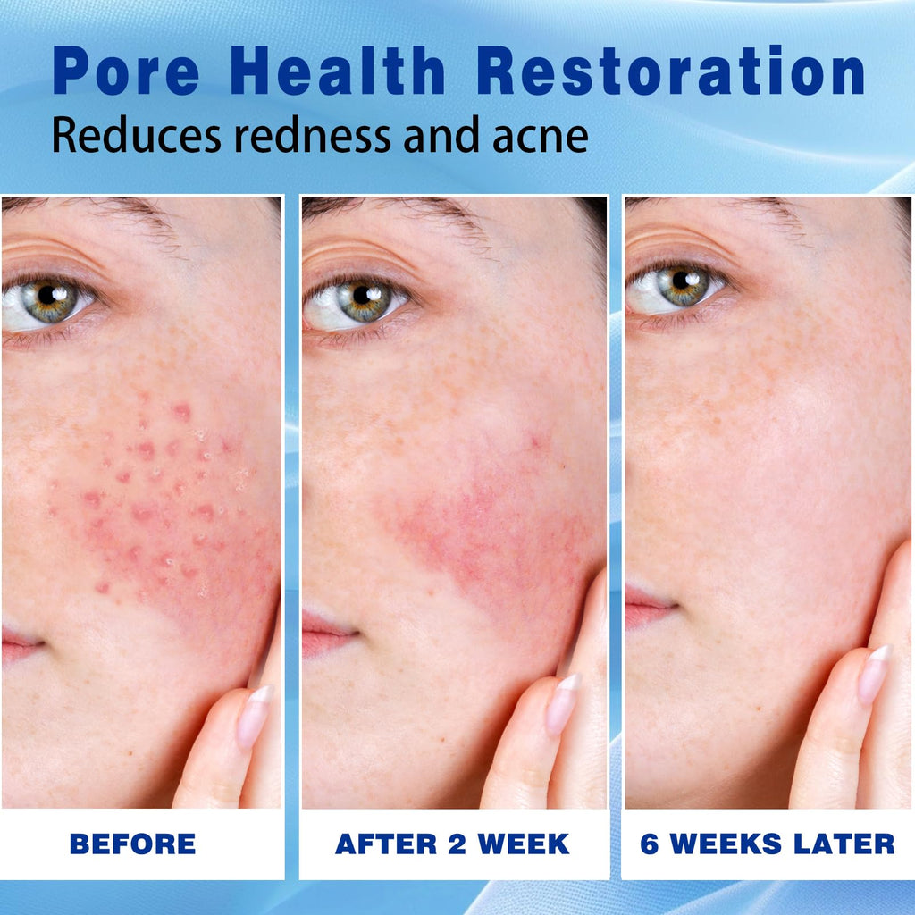 Sefralls 10% Azelaic Acid Cream — Acne & Redness Relief, 1 oz