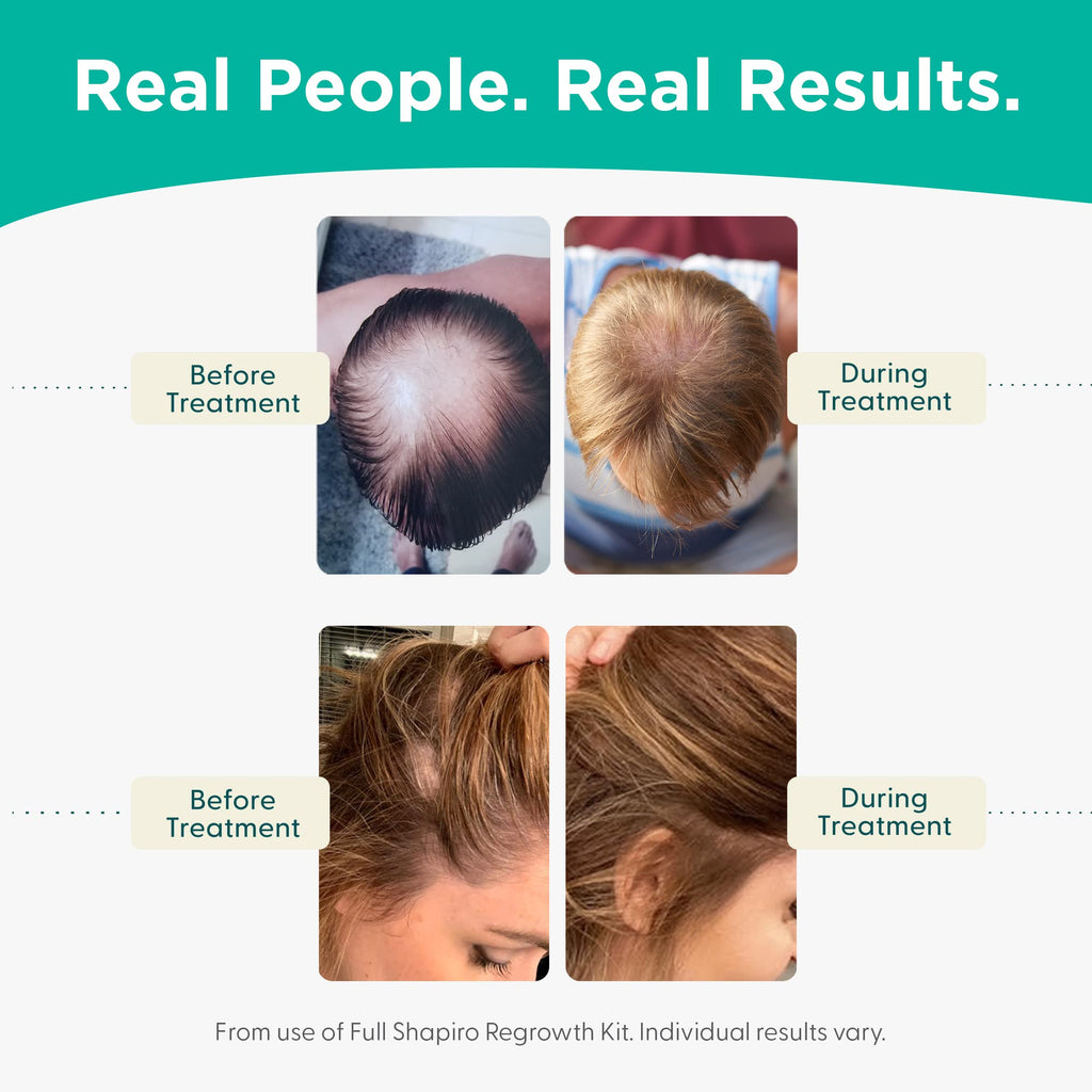 Shapiro MD Hair Growth Experts Leave-In Foam | Dermatologist-Developed DHT-Fighting Vegan Formula (2 Month Supply)