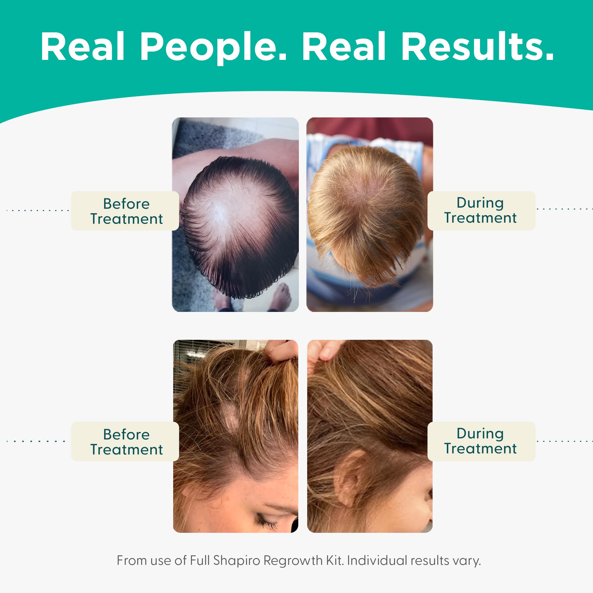 Shapiro MD Hair Growth Experts Leave-In Foam | Dermatologist-Developed DHT-Fighting Vegan Formula (2 Month Supply)
