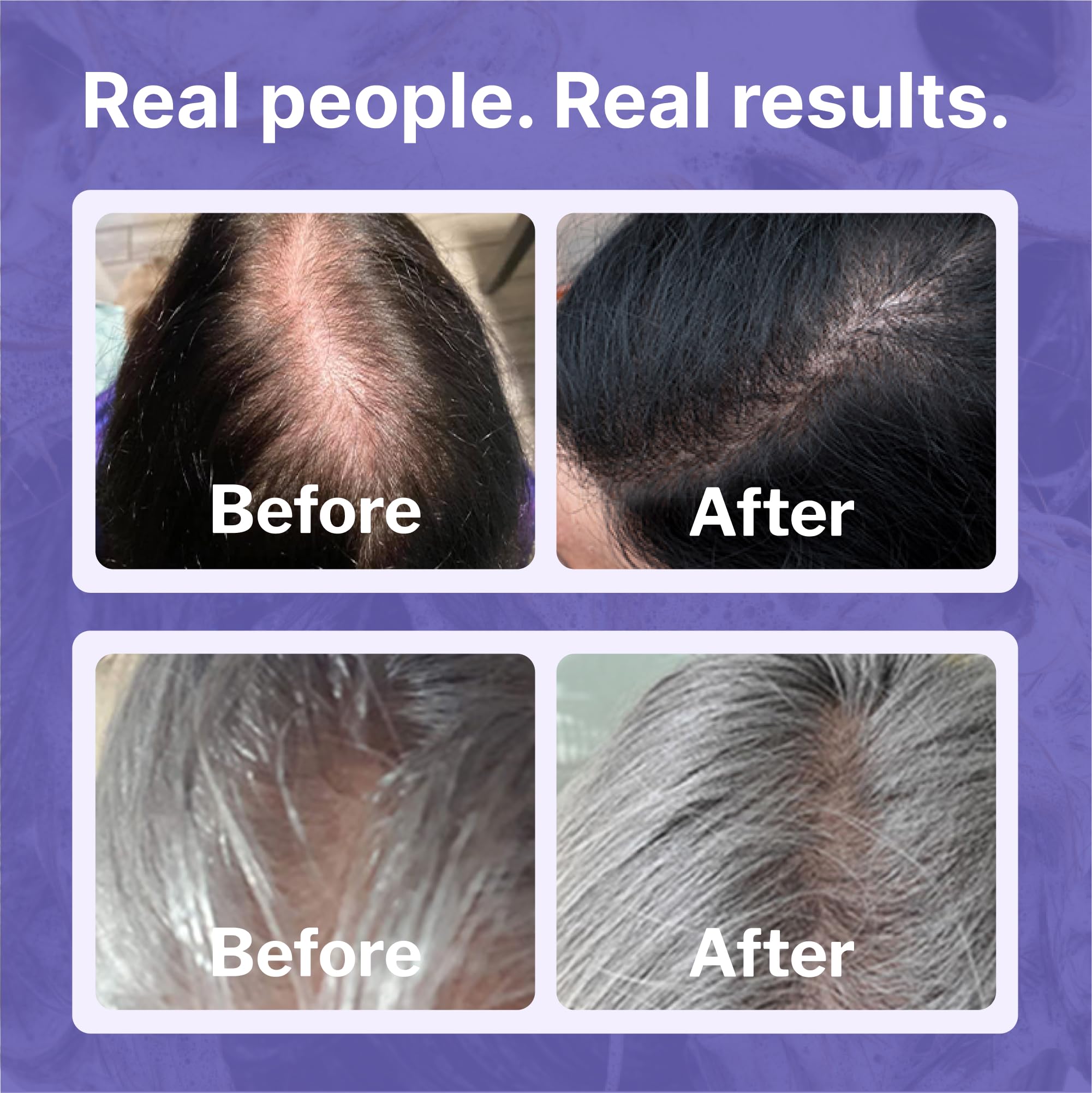 Shapiro MD Hair Growth Experts Minoxidil 2% for Women – Hair Growth Serum (1 Month)