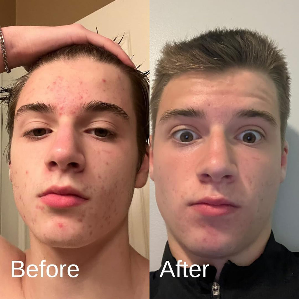 Shield Acne System for Men and Boys — Face Wash, Moisturizer & Pimple Patches (1 Month)