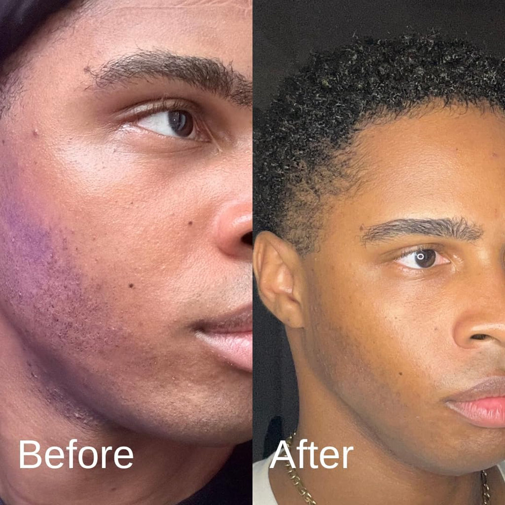 Shield Acne System for Men and Boys — Face Wash, Moisturizer & Pimple Patches (1 Month)