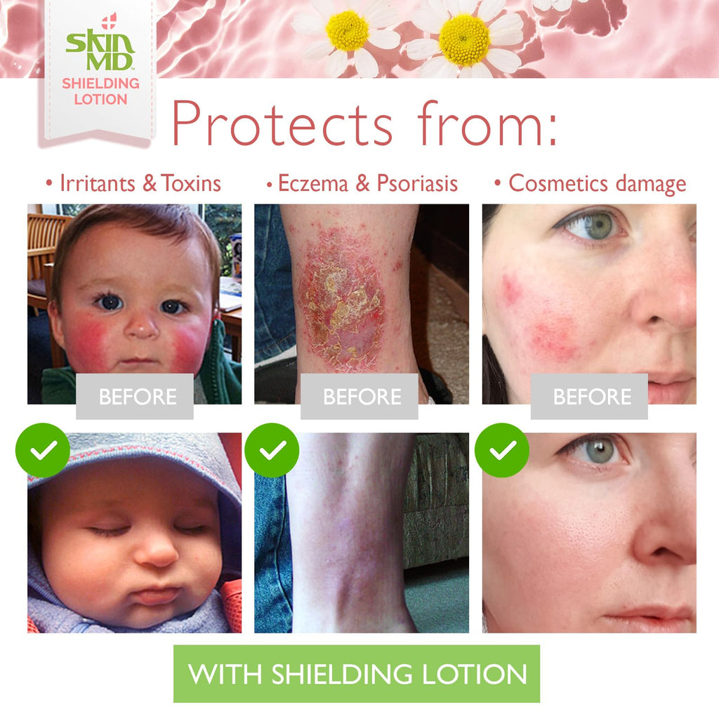 Skin MD Shielding Lotion – Fragrance-Free, Hypoallergenic Moisturizer for Face, Body & Hands | 8oz