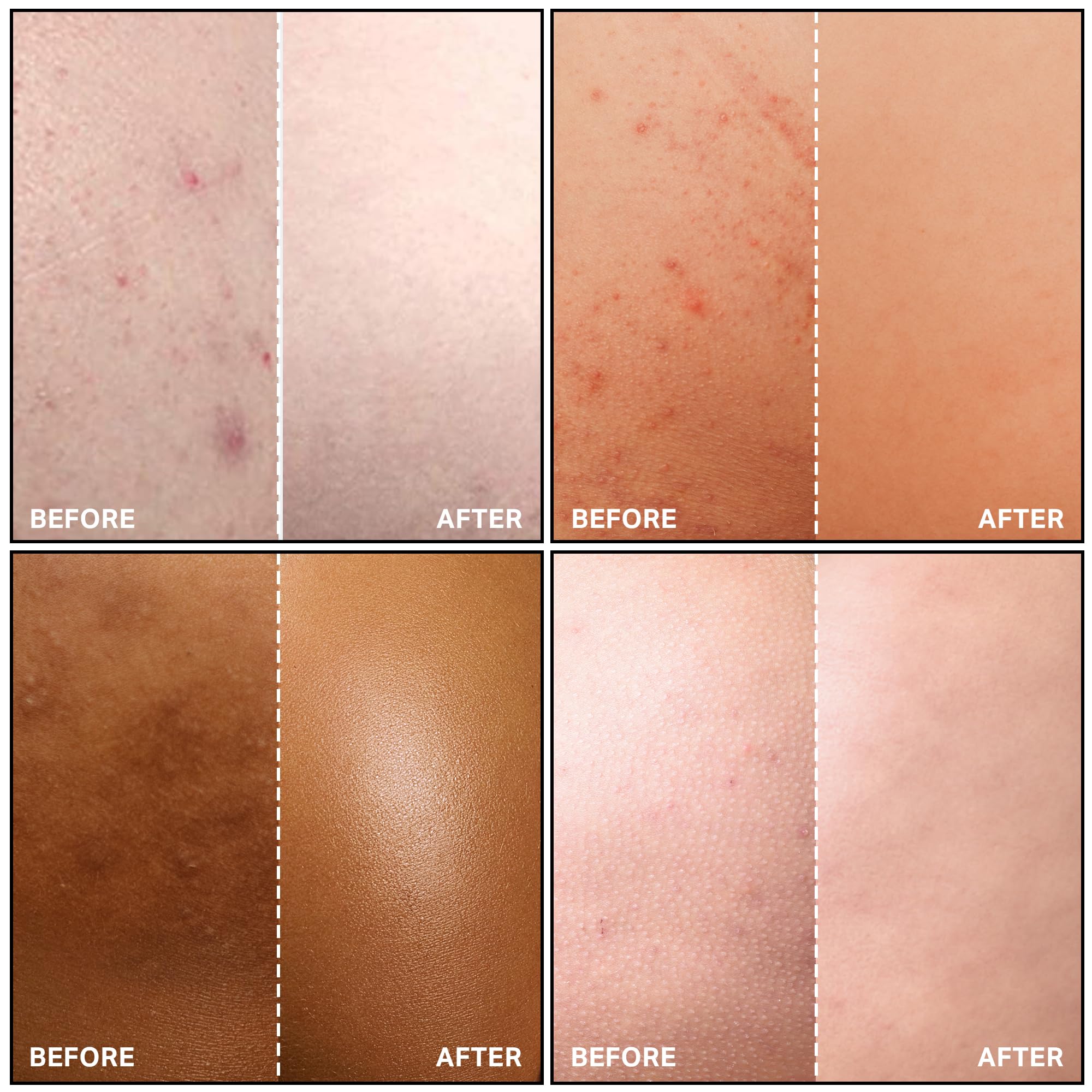 SKINBOSS Butt Acne Clearing Treatment – Hydrating Body Lotion for Back, Bum & Thighs (5 oz)