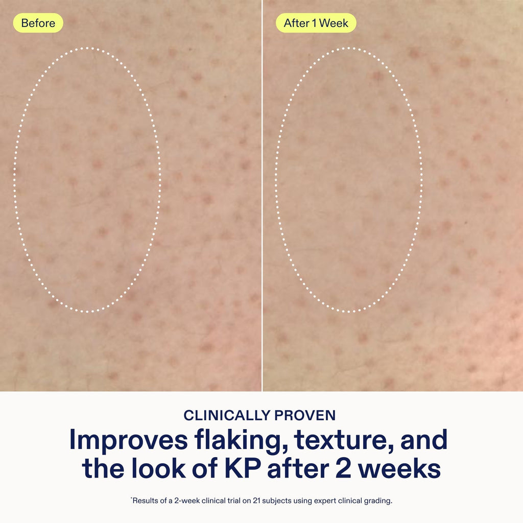 Skinfix KP + PsO Smoothing Body Treatment – 5.07 oz | Gentle KP & Psoriasis-Prone Skin