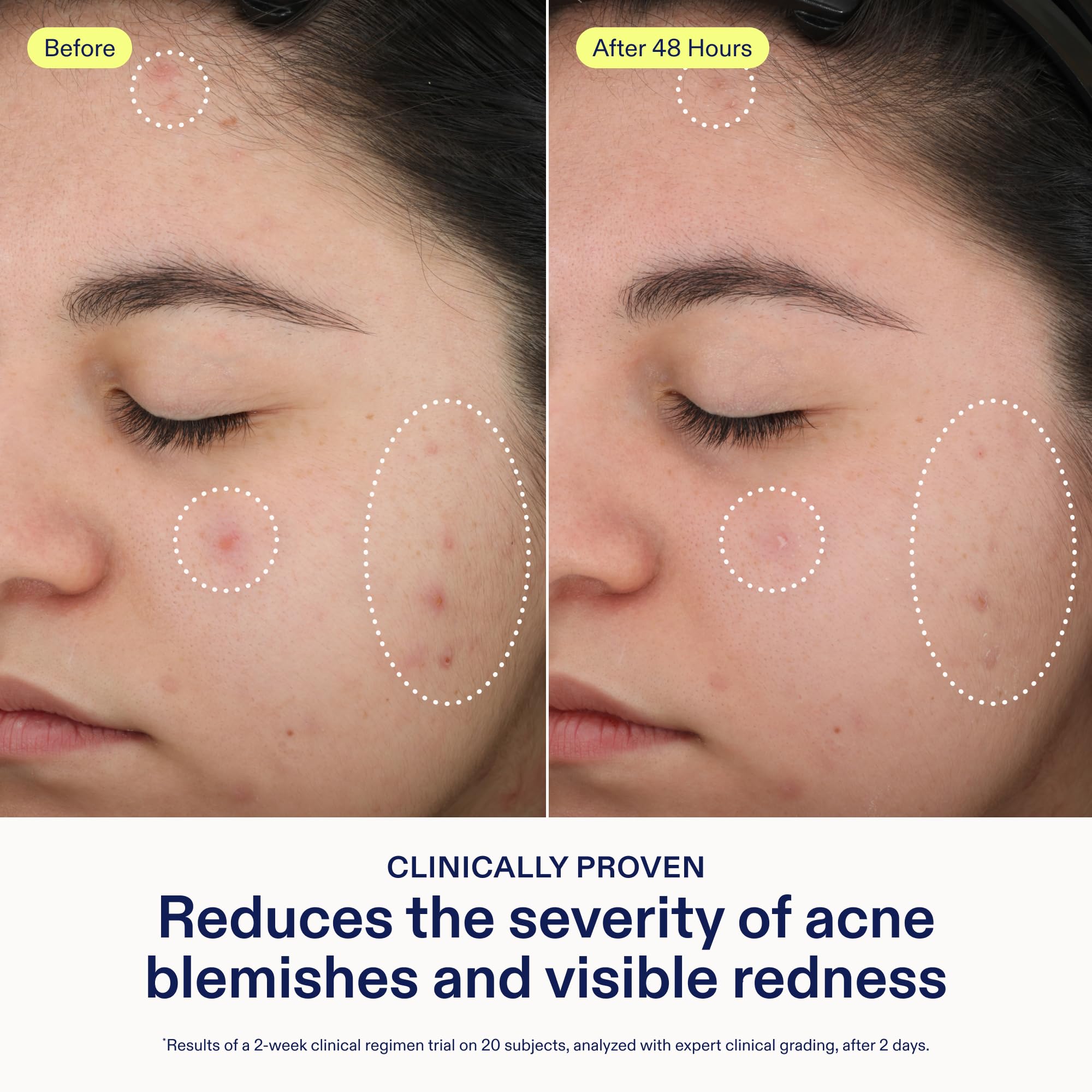 Skinfix 2% BHA Spot Treatment with Niacinamide – Fragrance-Free Acne Care (0.5 fl oz)