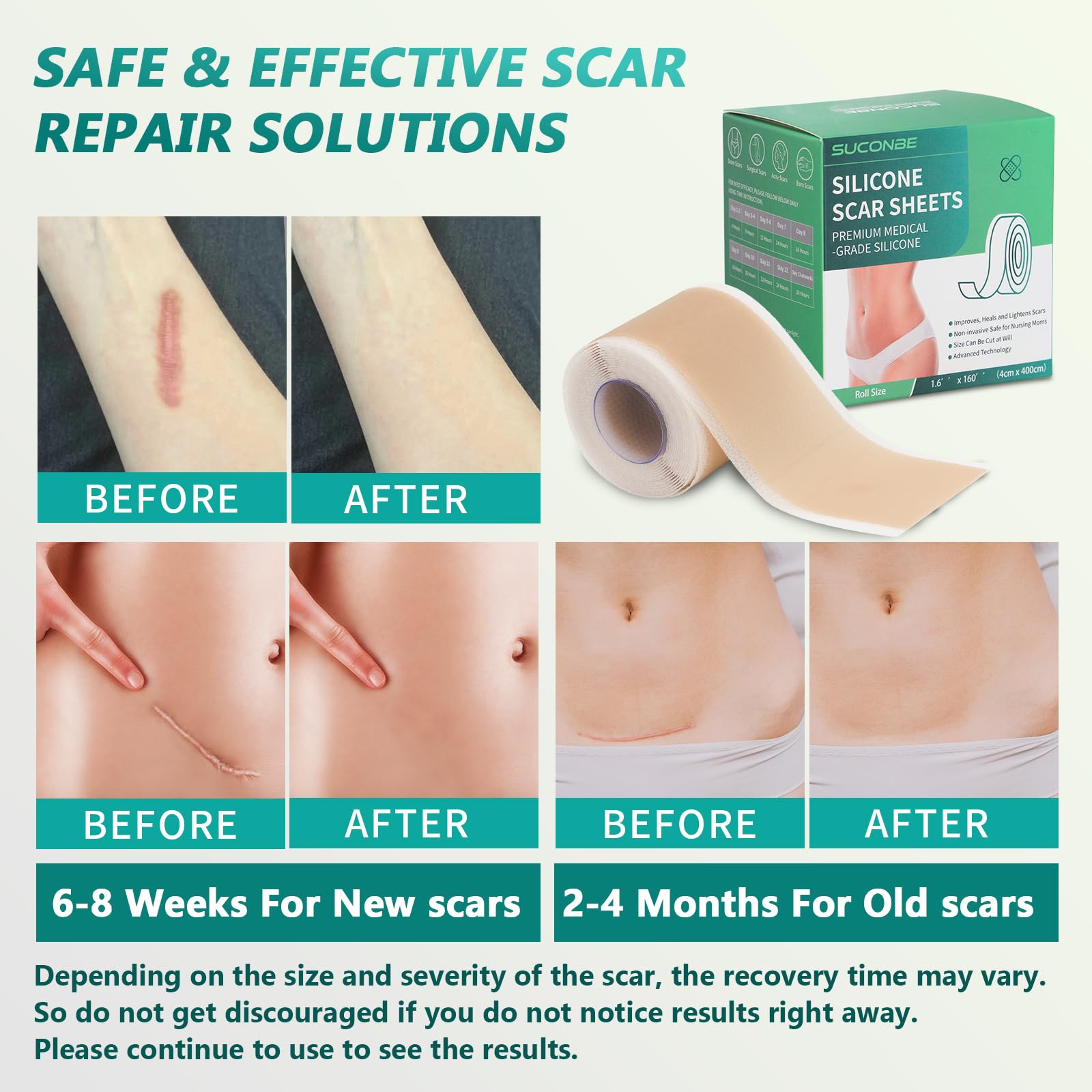 SUCONBE Silicone Scar Tape – Medical Grade Scar Sheets (1.6 x 160 in Roll) for C-Section, Tummy Tuck, and Post-Surgery Scars