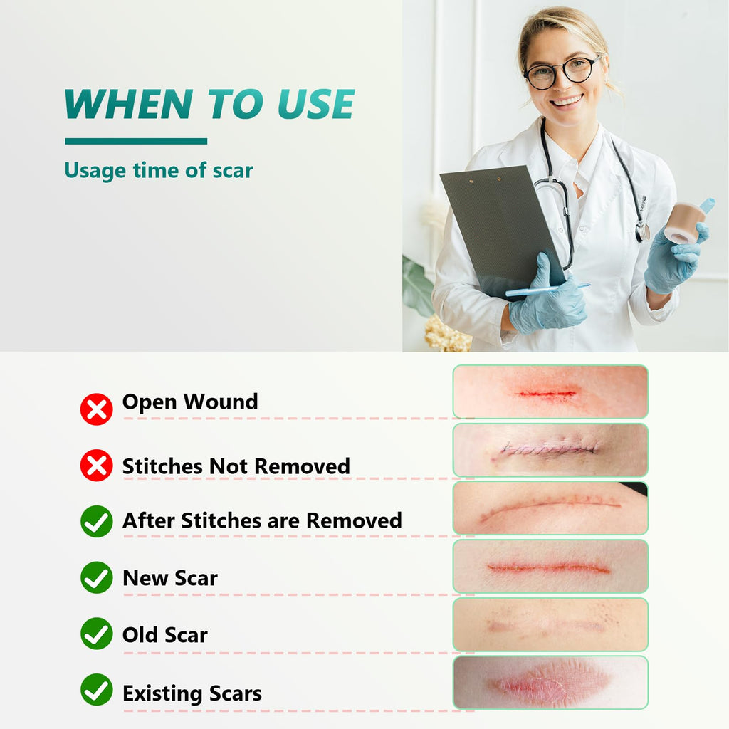 SUCONBE Silicone Scar Tape – Medical Grade Scar Sheets (1.6 x 160 in Roll) for C-Section, Tummy Tuck, and Post-Surgery Scars