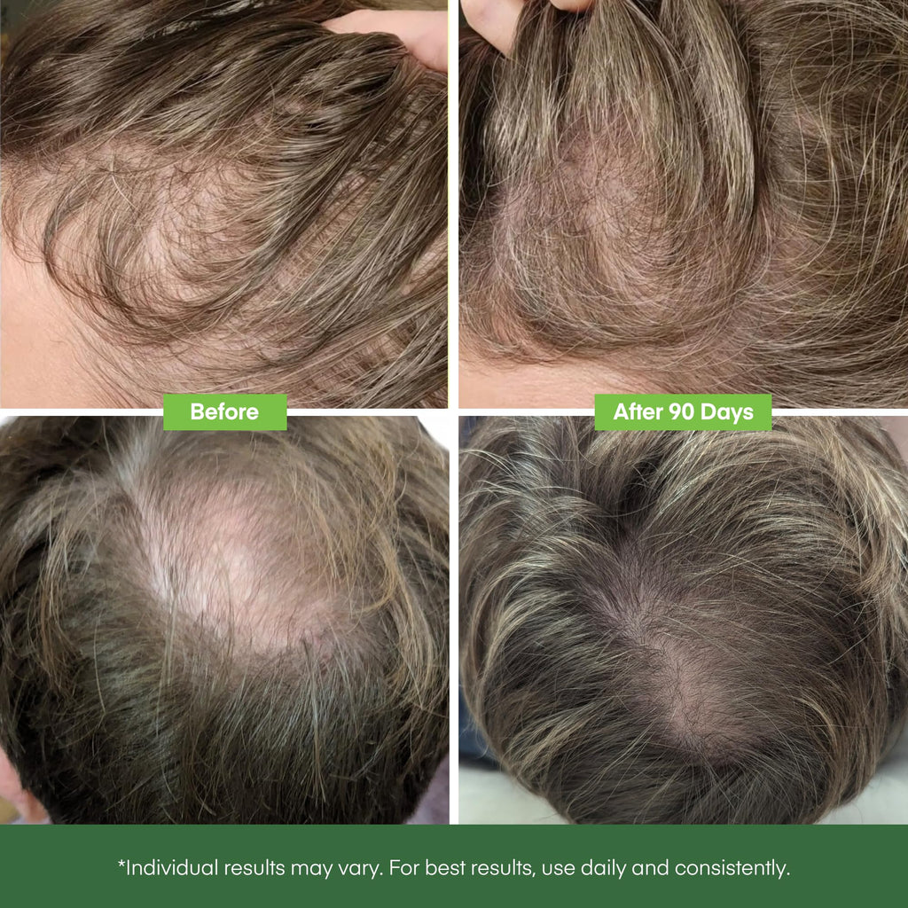 Svvimer Hair Growth Serum Roll-On – 2x15ml with Biotin, Rosemary & Batana Oil for Thicker-Looking Hair