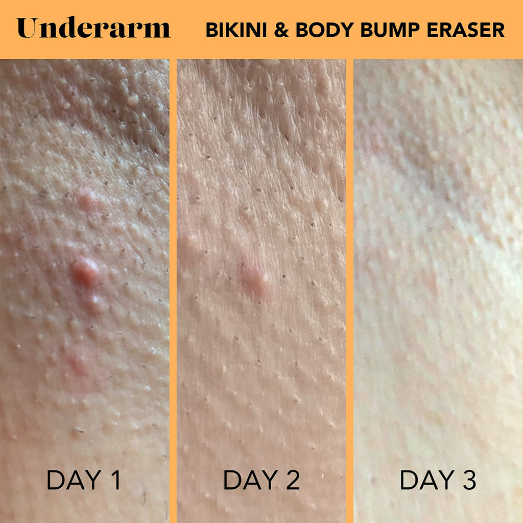 SweetSpot Labs Bikini & Body Bump Eraser – Pack of 2 x 0.5oz | Niacinamide & Bentonite Clay