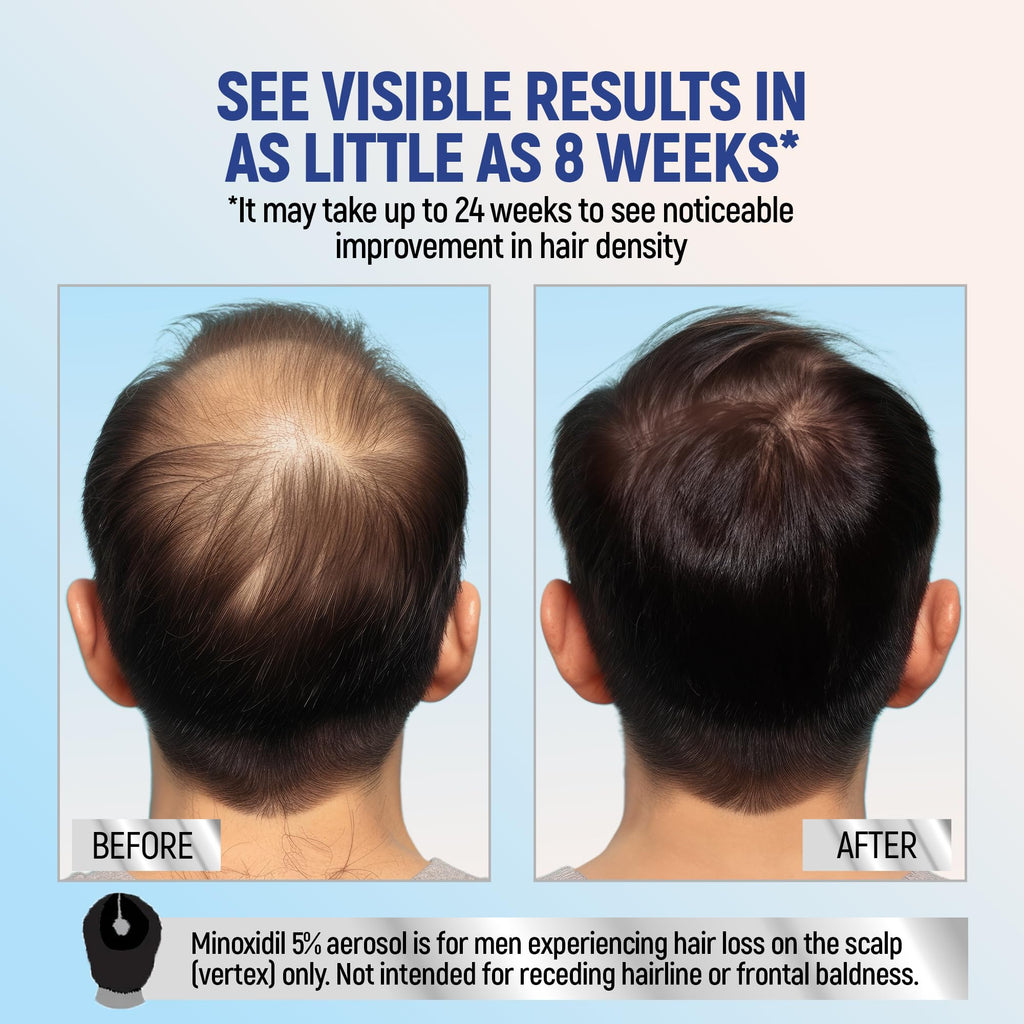 TARO Minoxidil 5% Topical Foam for Men – 2 Month, 2-Pack, 2.11 oz