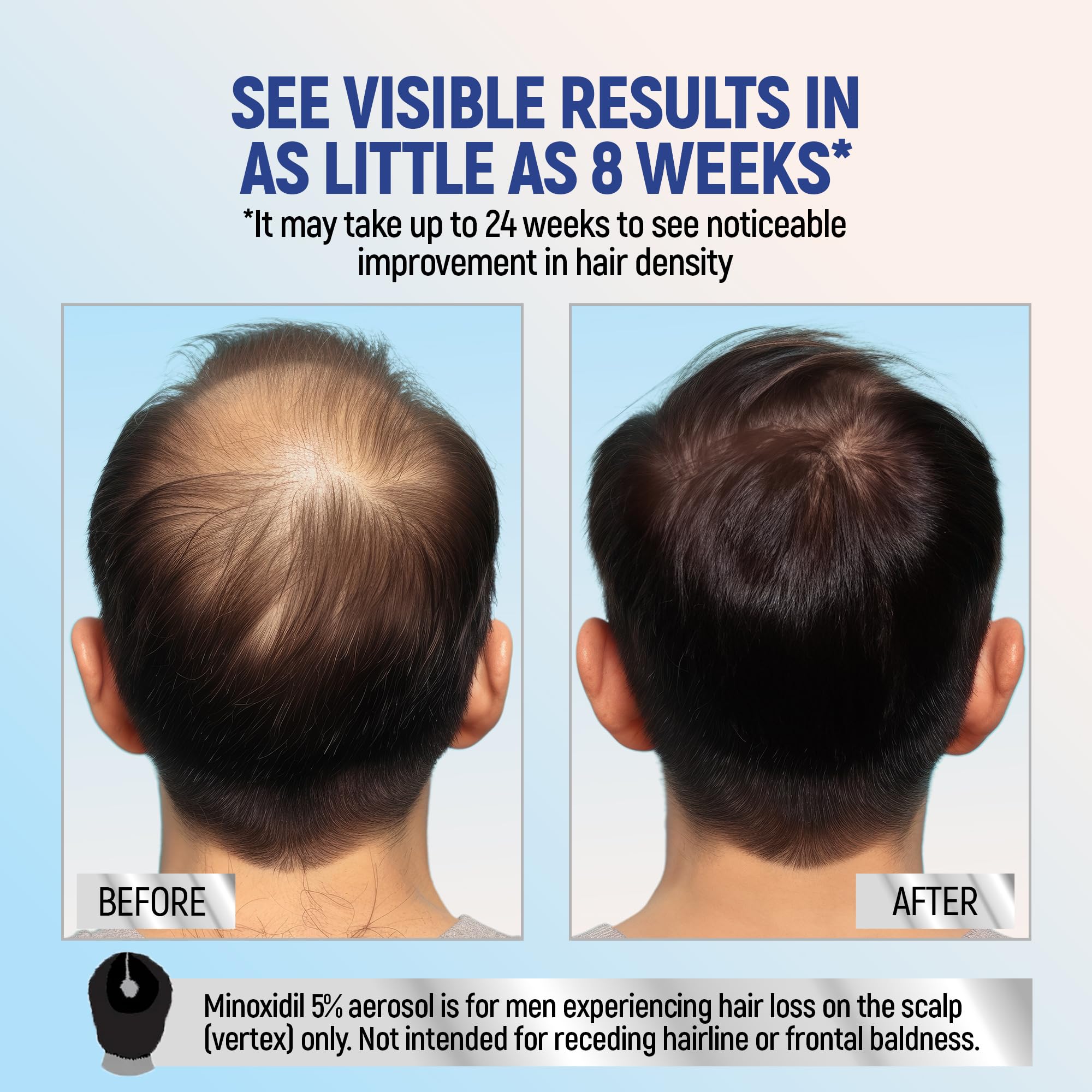 TARO Minoxidil 5% Topical Foam for Men – 2 Month, 2-Pack, 2.11 oz
