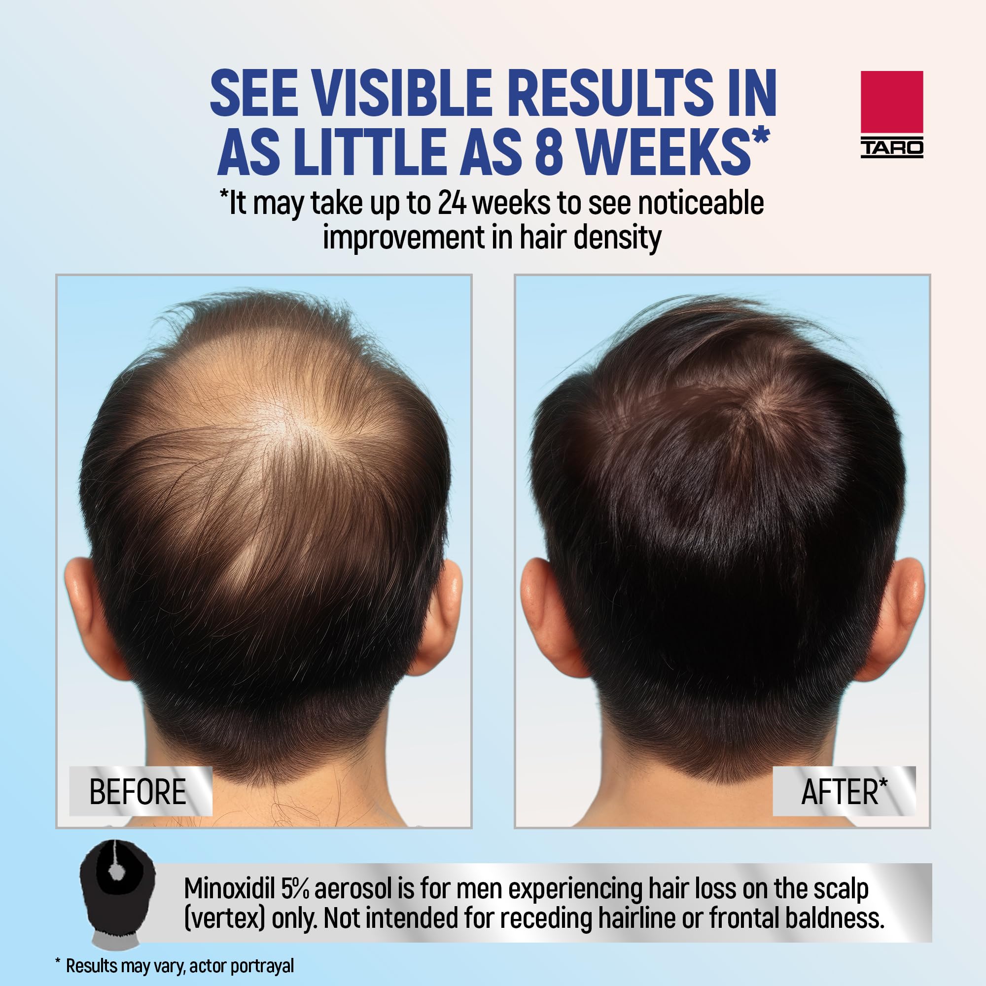 TARO Minoxidil 5% Foam for Men – 2.11 Oz Topical Hair Regrowth Solution (1 Month Supply)