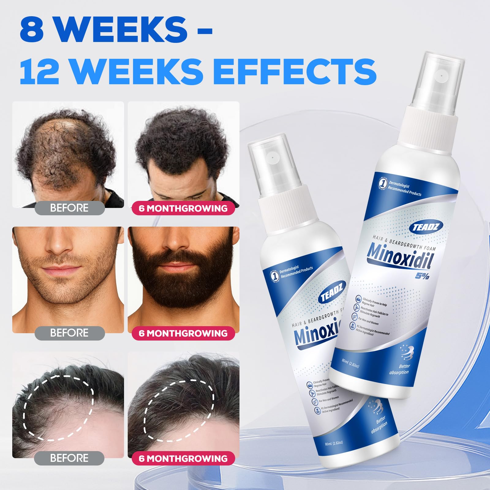 TEADZ 5% Minoxidil for Men and Women – Intense Hair Growth Serum (2 x 2.82 oz)