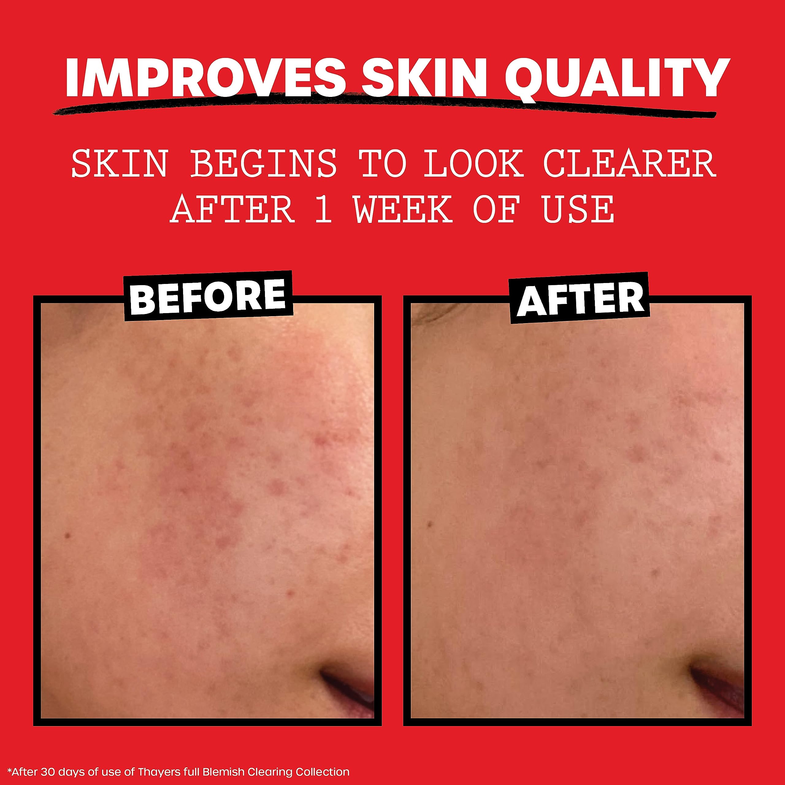 THAYERS Witch Hazel Blemish Cleanser, 4 oz  2% Salicylic Acid