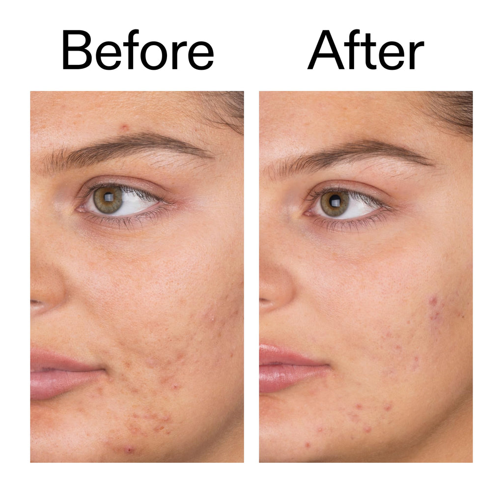 The INKEY List Salicylic Acid Cleanser – Daily Exfoliating Cleanser with 2% SA + Zinc PCA