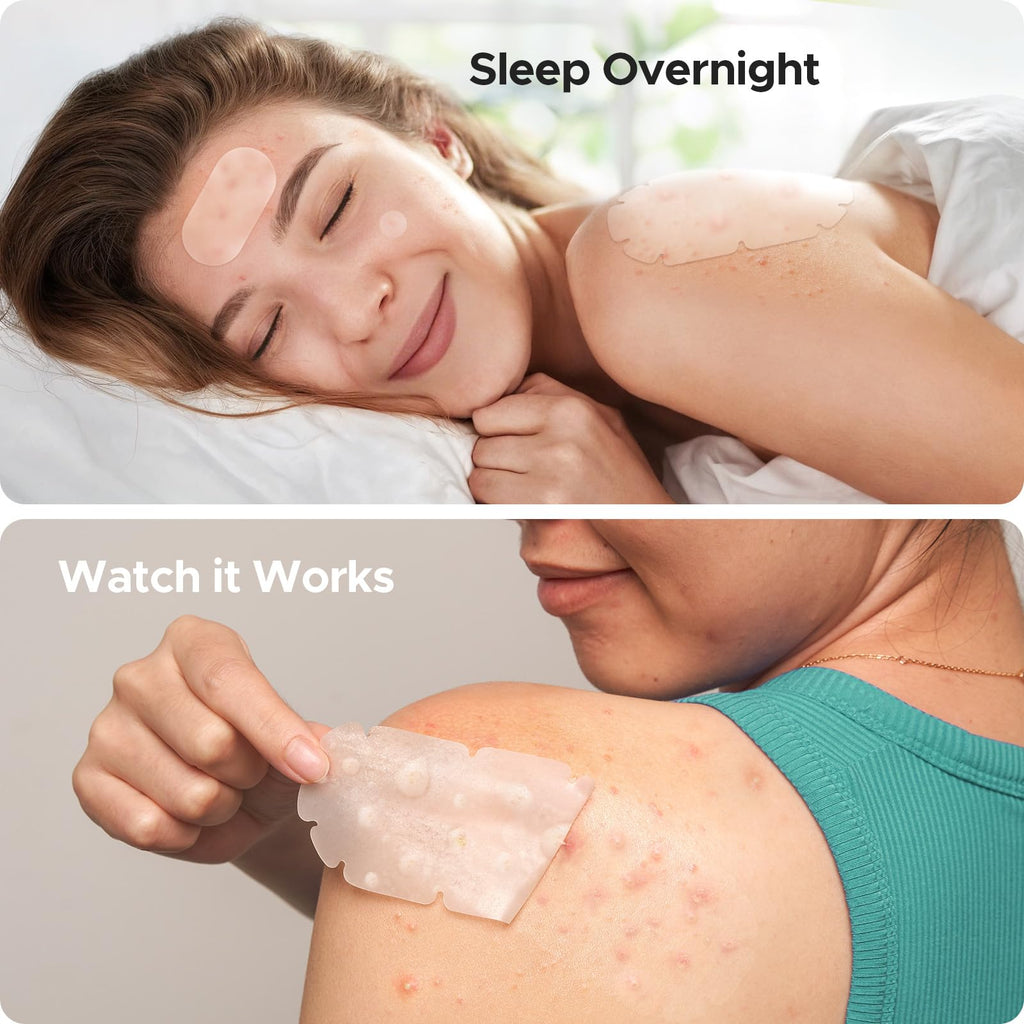 TKTK XXL Body Acne Patches – 5 Sizes, 260 Large Hydrocolloid Patches for Back, Chest & Shoulders