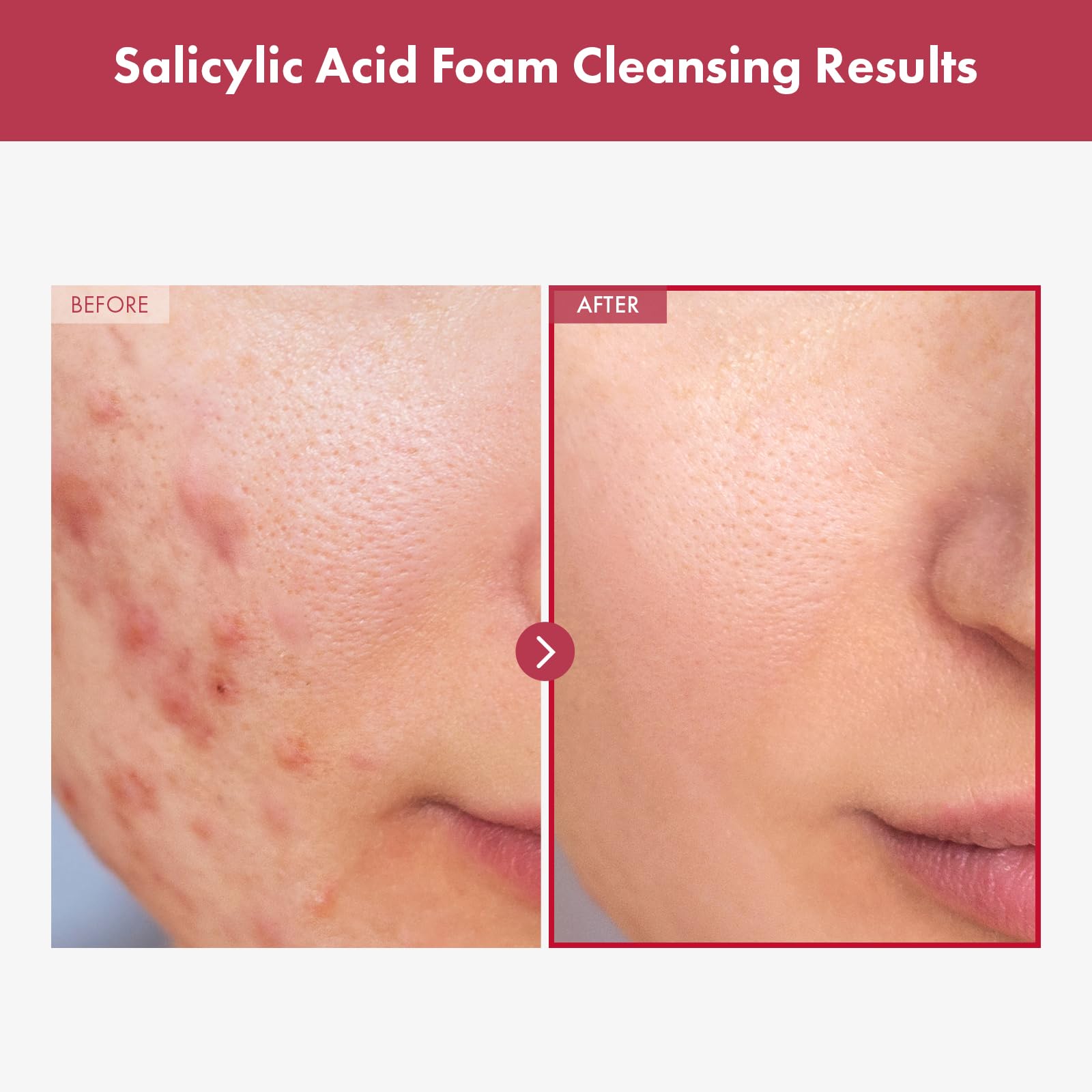 TOSOWOONG Salicylic Acid Foam Cleanser – Deep Pore Cleansing for Oily Skin, 18,000ppm SA, 100ml