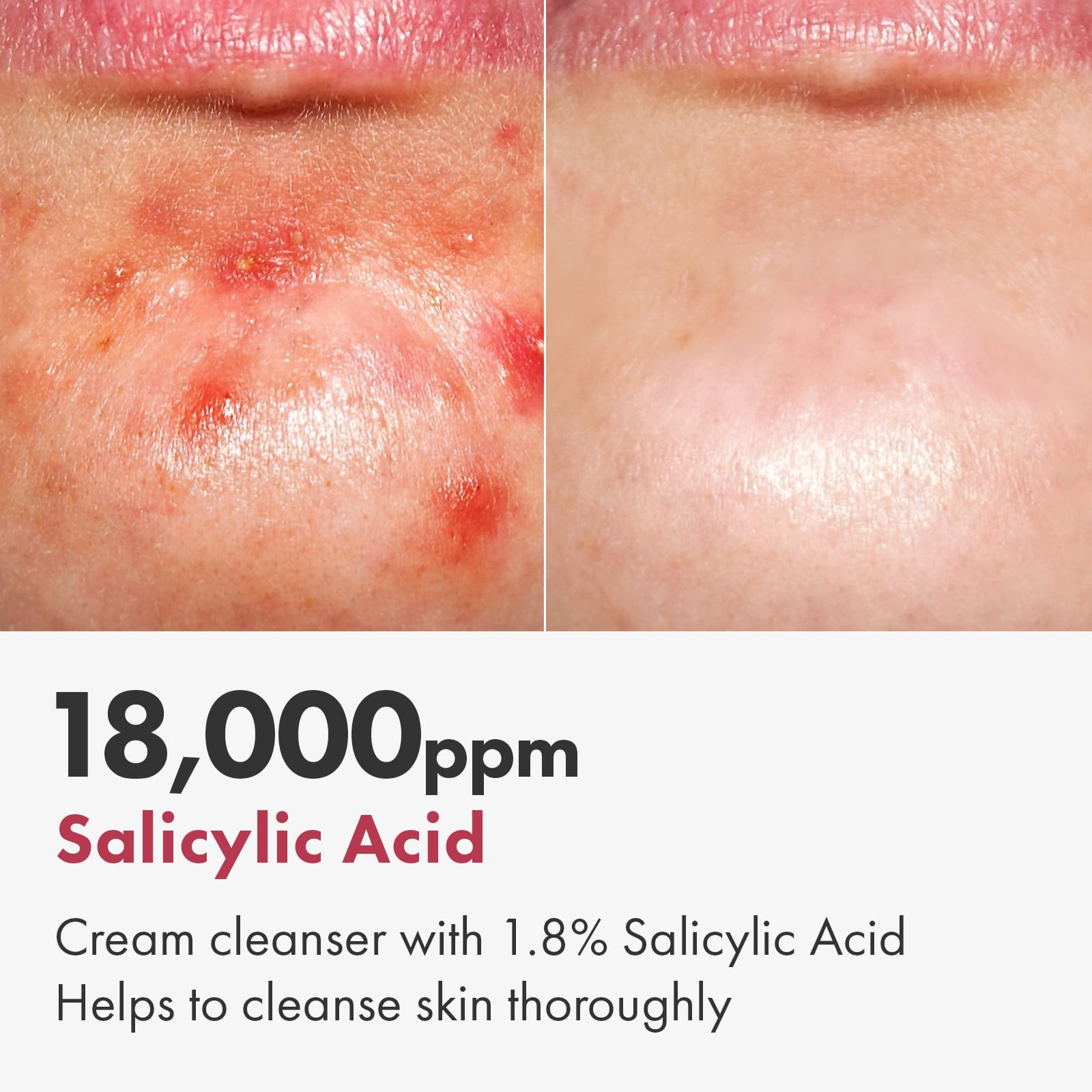 TOSOWOONG Salicylic Acid Foam Cleanser – Deep Pore Cleansing for Oily Skin, 18,000ppm SA, 100ml