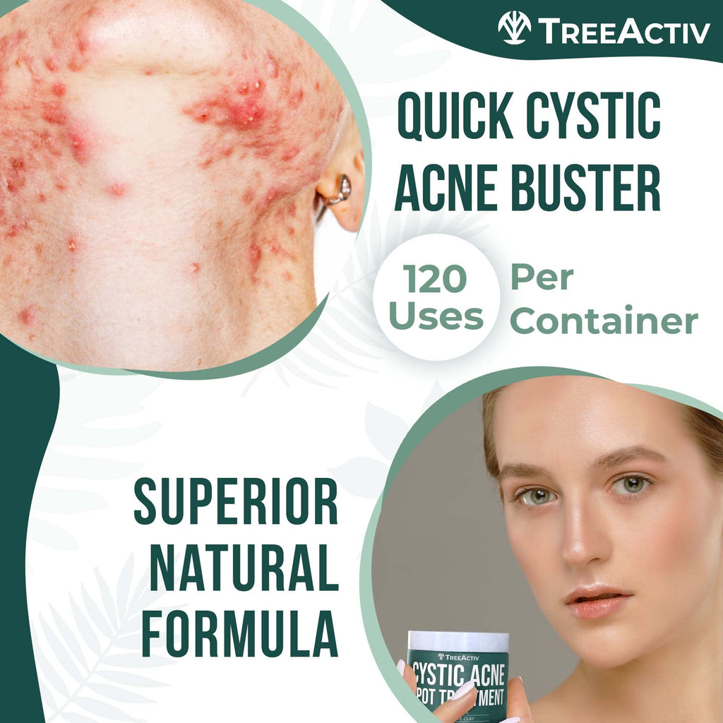 TreeActiv Cystic Acne Spot Treatment – Overnight Sulfur & Bentonite Clay for Face & Body • 0.5oz